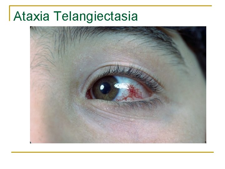 Ataxia Telangiectasia 