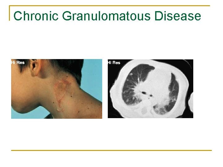 Chronic Granulomatous Disease 