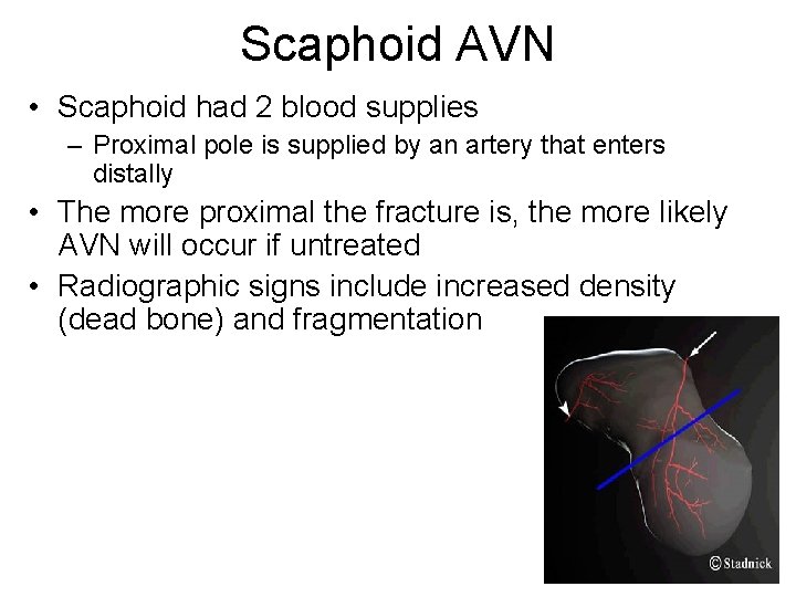 Scaphoid AVN • Scaphoid had 2 blood supplies – Proximal pole is supplied by