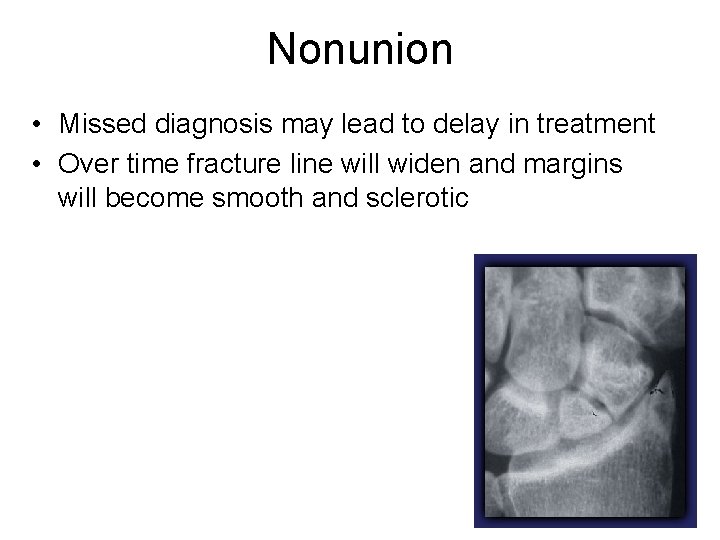 Nonunion • Missed diagnosis may lead to delay in treatment • Over time fracture