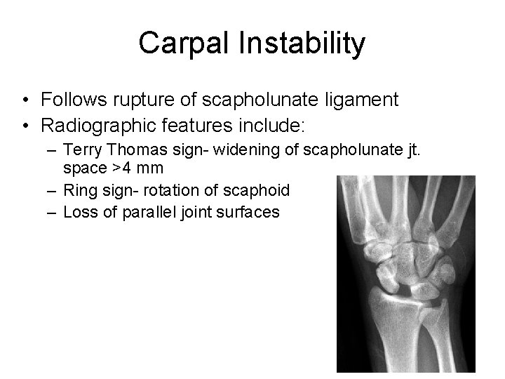 Carpal Instability • Follows rupture of scapholunate ligament • Radiographic features include: – Terry