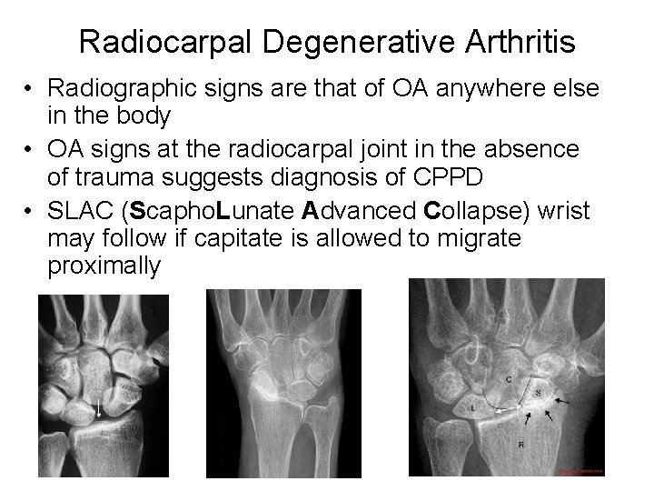 Radiocarpal Degenerative Arthritis • Radiographic signs are that of OA anywhere else in the