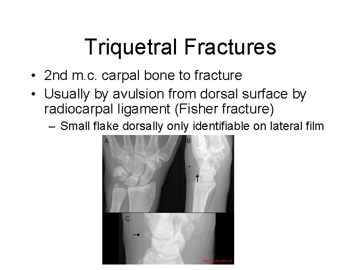 Triquetral Fractures • 2 nd m. c. carpal bone to fracture • Usually by