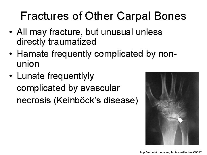 Fractures of Other Carpal Bones • All may fracture, but unusual unless directly traumatized