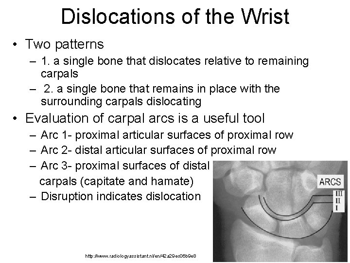 Dislocations of the Wrist • Two patterns – 1. a single bone that dislocates