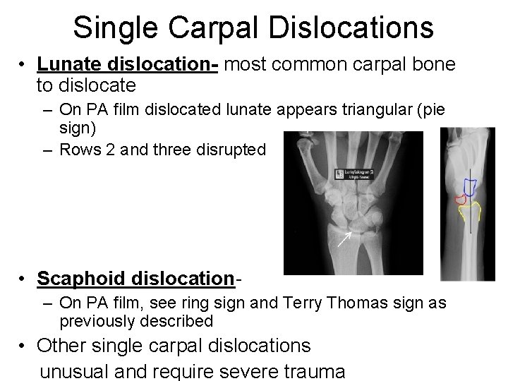 Single Carpal Dislocations • Lunate dislocation- most common carpal bone to dislocate – On