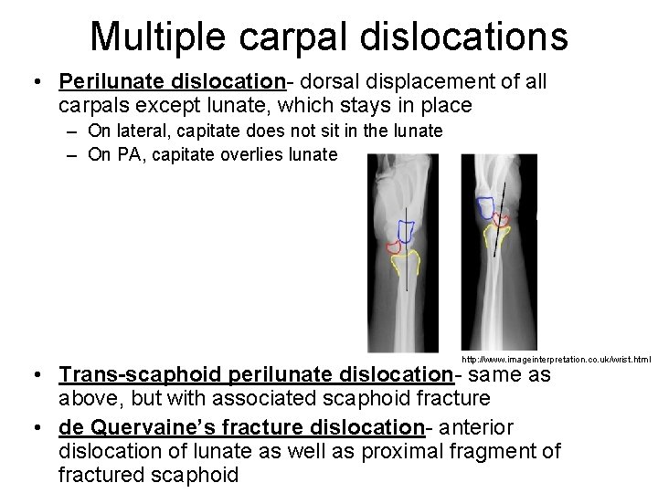 Multiple carpal dislocations • Perilunate dislocation- dorsal displacement of all carpals except lunate, which