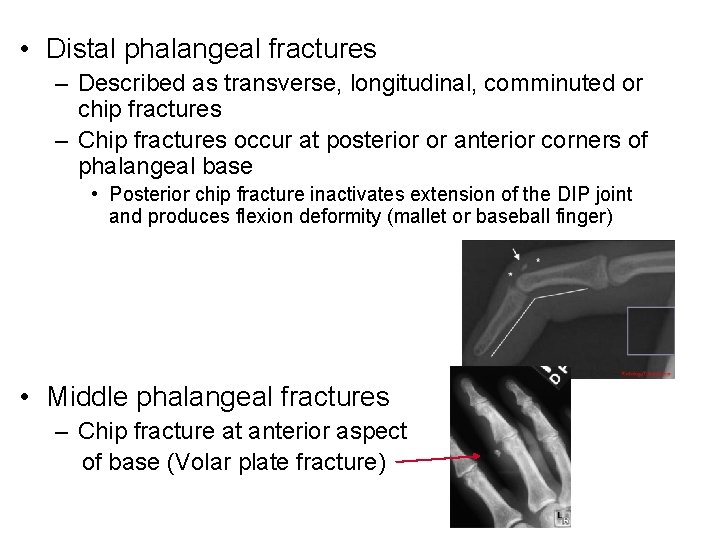  • Distal phalangeal fractures – Described as transverse, longitudinal, comminuted or chip fractures