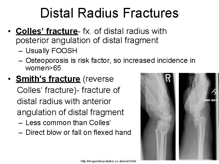 Distal Radius Fractures • Colles’ fracture- fx. of distal radius with posterior angulation of