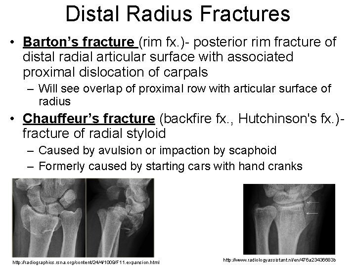 Distal Radius Fractures • Barton’s fracture (rim fx. )- posterior rim fracture of distal