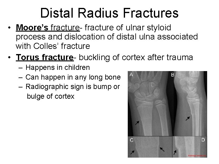 Distal Radius Fractures • Moore’s fracture- fracture of ulnar styloid process and dislocation of