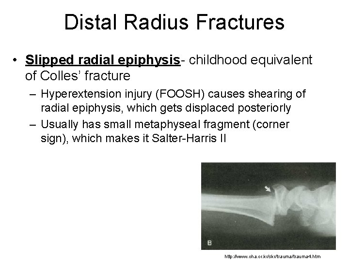 Distal Radius Fractures • Slipped radial epiphysis- childhood equivalent of Colles’ fracture – Hyperextension