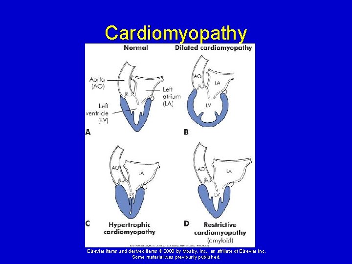 Cardiomyopathy Elsevier items and derived items © 2008 by Mosby, Inc. , an affiliate Cardiomyopathy Elsevier items and derived items © 2008 by Mosby, Inc. , an affiliate