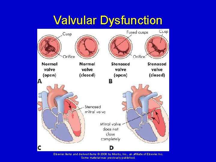 Valvular Dysfunction Elsevier items and derived items © 2008 by Mosby, Inc. , an Valvular Dysfunction Elsevier items and derived items © 2008 by Mosby, Inc. , an