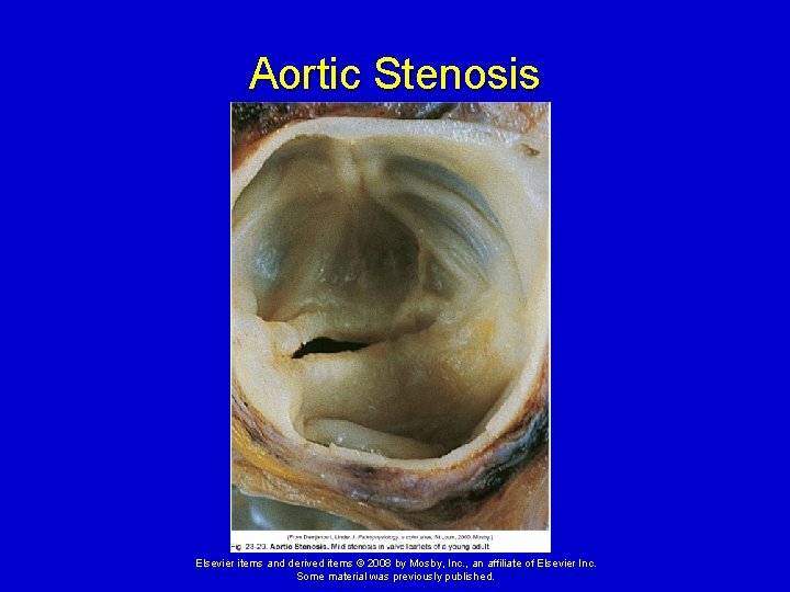 Aortic Stenosis Elsevier items and derived items © 2008 by Mosby, Inc. , an Aortic Stenosis Elsevier items and derived items © 2008 by Mosby, Inc. , an