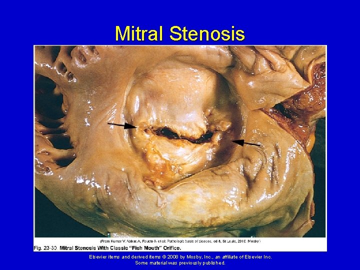 Mitral Stenosis Elsevier items and derived items © 2008 by Mosby, Inc. , an Mitral Stenosis Elsevier items and derived items © 2008 by Mosby, Inc. , an