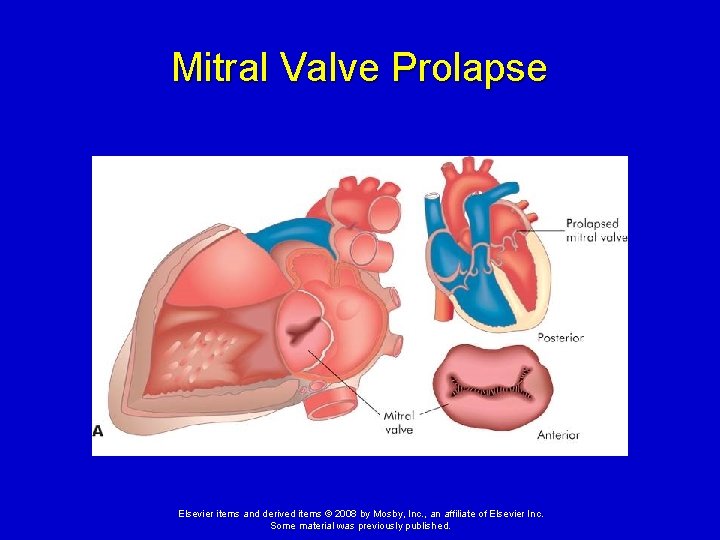 Mitral Valve Prolapse Elsevier items and derived items © 2008 by Mosby, Inc. , Mitral Valve Prolapse Elsevier items and derived items © 2008 by Mosby, Inc. ,