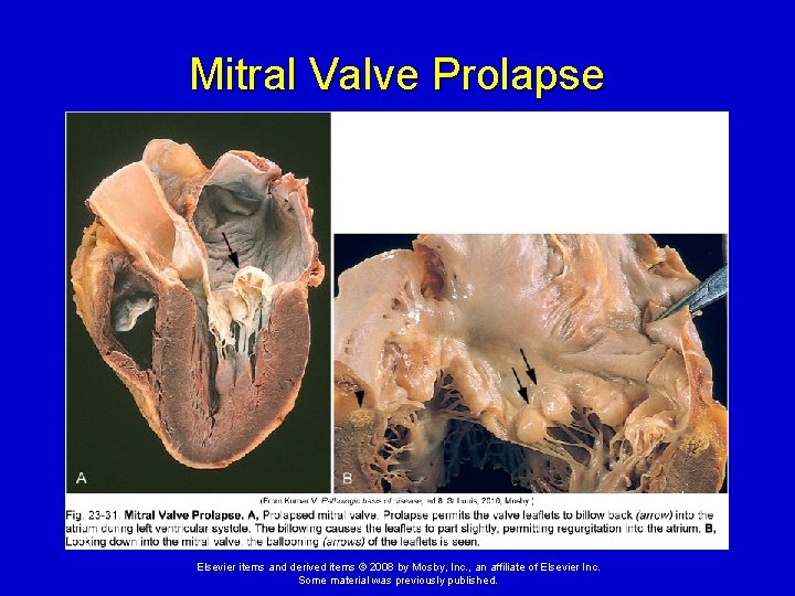 Mitral Valve Prolapse Elsevier items and derived items © 2008 by Mosby, Inc. , Mitral Valve Prolapse Elsevier items and derived items © 2008 by Mosby, Inc. ,