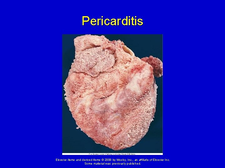 Pericarditis Elsevier items and derived items © 2008 by Mosby, Inc. , an affiliate Pericarditis Elsevier items and derived items © 2008 by Mosby, Inc. , an affiliate