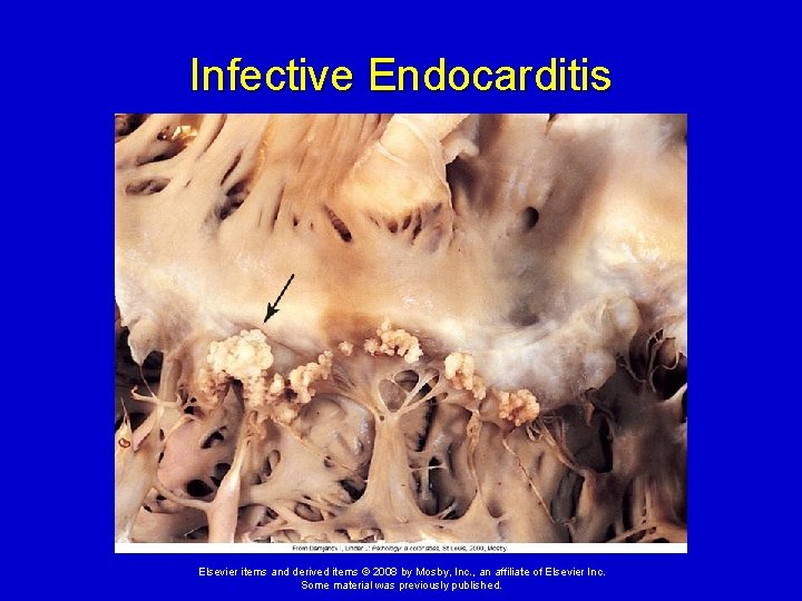 Infective Endocarditis Elsevier items and derived items © 2008 by Mosby, Inc. , an Infective Endocarditis Elsevier items and derived items © 2008 by Mosby, Inc. , an