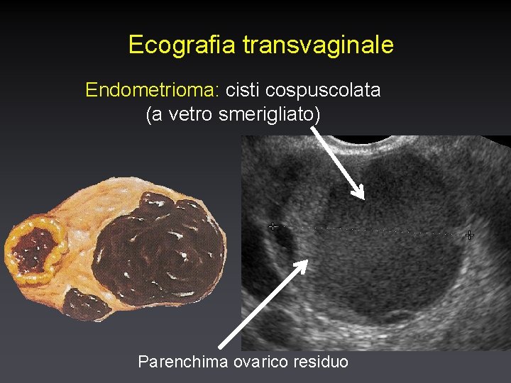 Ecografia transvaginale Endometrioma: cisti cospuscolata (a vetro smerigliato) Parenchima ovarico residuo 