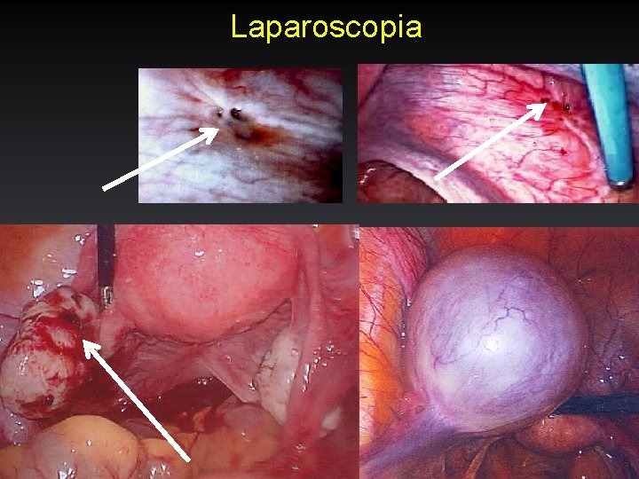 Laparoscopia 