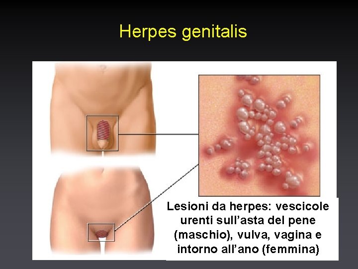 Herpes genitalis Lesioni da herpes: vescicole urenti sull’asta del pene (maschio), vulva, vagina e