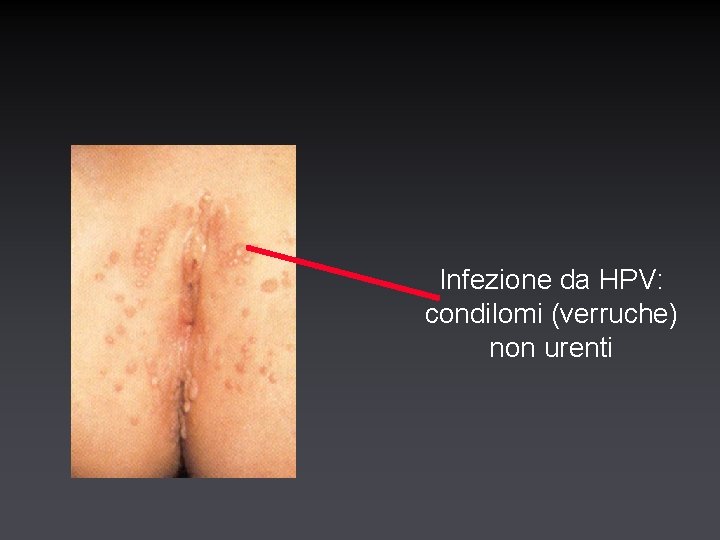 Infezione da HPV: condilomi (verruche) non urenti 
