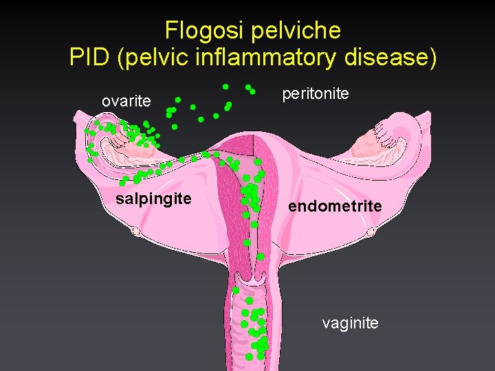 Flogosi pelviche PID (pelvic inflammatory disease) ovarite salpingite peritonite endometrite vaginite 