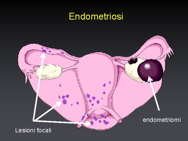 Endometriosi endometriomi Lesioni focali 
