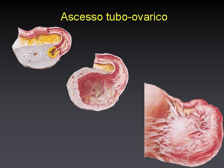 Ascesso tubo-ovarico 