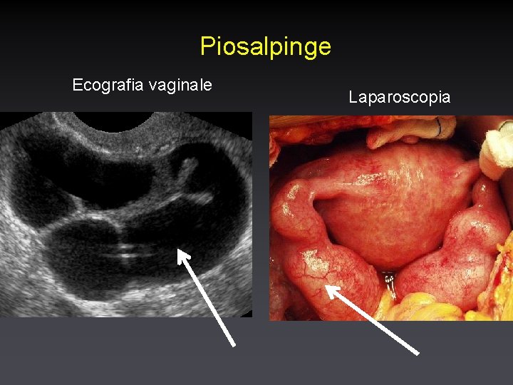 Piosalpinge Ecografia vaginale Laparoscopia 