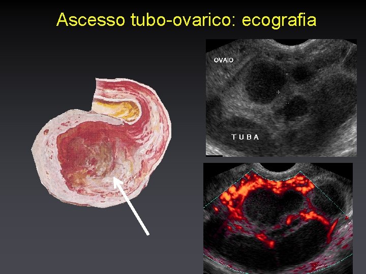 Ascesso tubo-ovarico: ecografia 