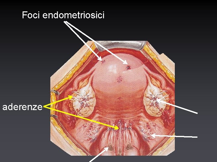Foci endometriosici aderenze 