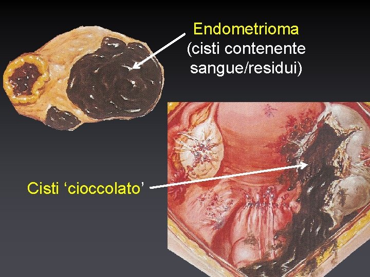 Endometrioma (cisti contenente sangue/residui) Cisti ‘cioccolato’ 