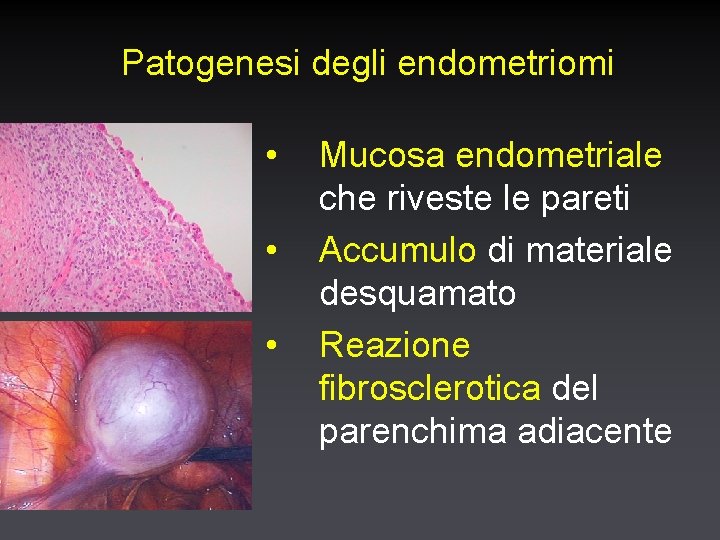 Patogenesi degli endometriomi • • • Mucosa endometriale che riveste le pareti Accumulo di