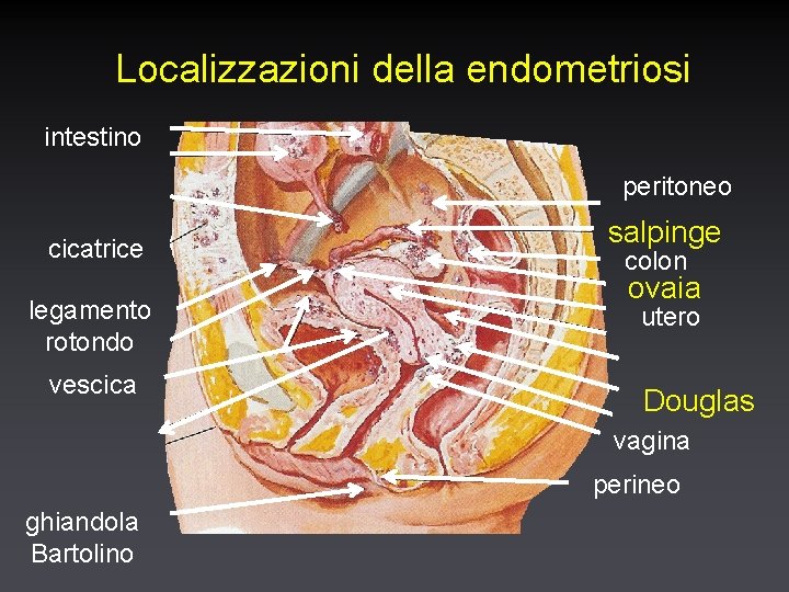 Localizzazioni della endometriosi intestino peritoneo cicatrice legamento rotondo vescica salpinge colon ovaia utero Douglas