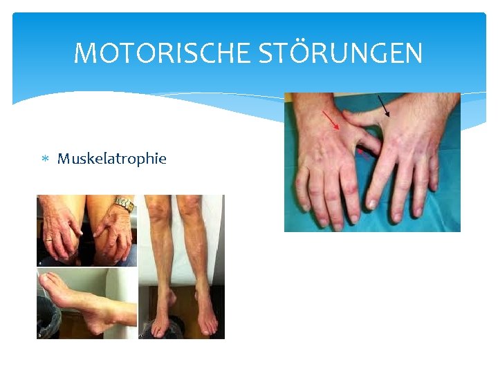 MOTORISCHE STÖRUNGEN Muskelatrophie MOTORISCHE STÖRUNGEN Muskelatrophie