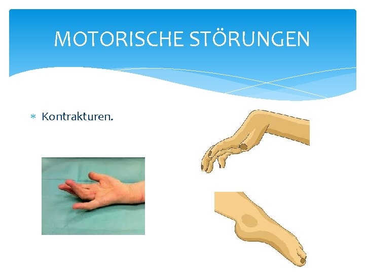 MOTORISCHE STÖRUNGEN Kontrakturen. MOTORISCHE STÖRUNGEN Kontrakturen.