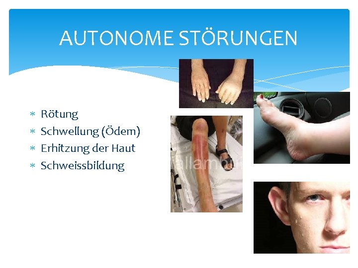 AUTONOME STÖRUNGEN Rötung Schwellung (Ödem) Erhitzung der Haut Schweissbildung AUTONOME STÖRUNGEN Rötung Schwellung (Ödem) Erhitzung der Haut Schweissbildung