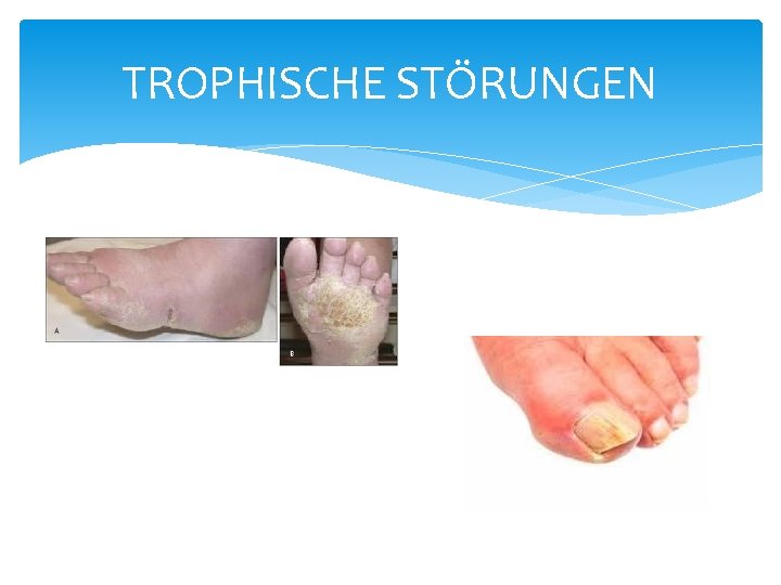 TROPHISCHE STÖRUNGEN TROPHISCHE STÖRUNGEN