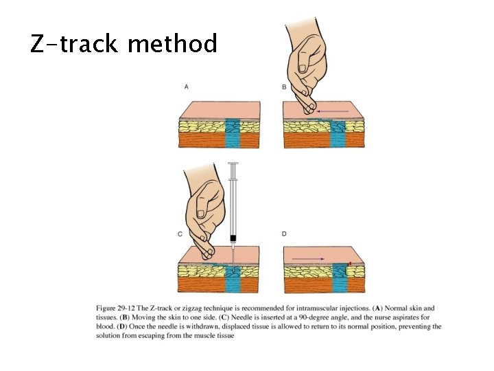 Z-track method 