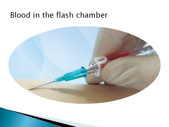 Blood in the flash chamber 