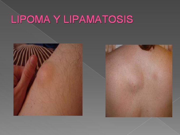 LIPOMA Y LIPAMATOSIS 