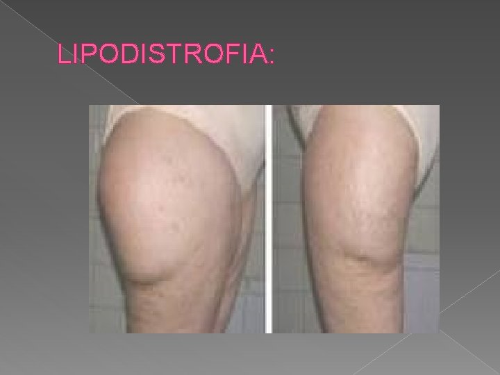 LIPODISTROFIA: 