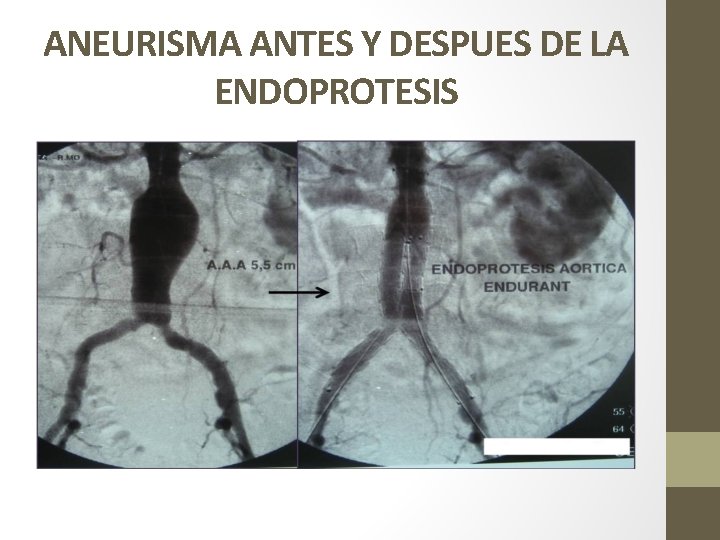 ANEURISMA ANTES Y DESPUES DE LA ENDOPROTESIS 