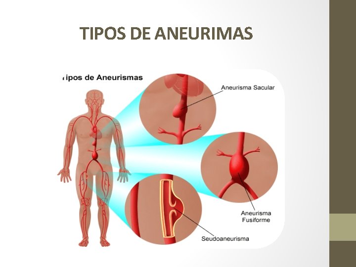 TIPOS DE ANEURIMAS 