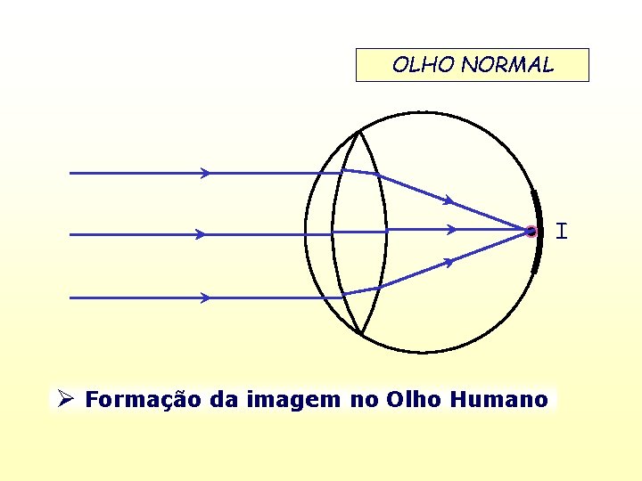 OLHO NORMAL I Formação da imagem no Olho Humano 