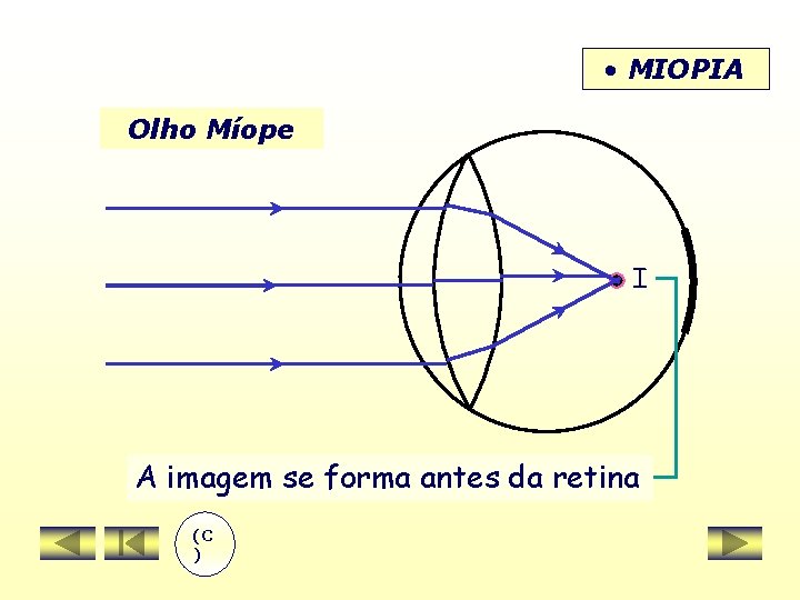  • MIOPIA Olho Míope I A imagem se forma antes da retina (C