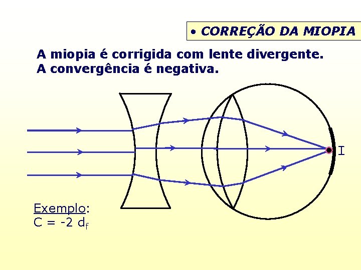  • CORREÇÃO DA MIOPIA A miopia é corrigida com lente divergente. A convergência